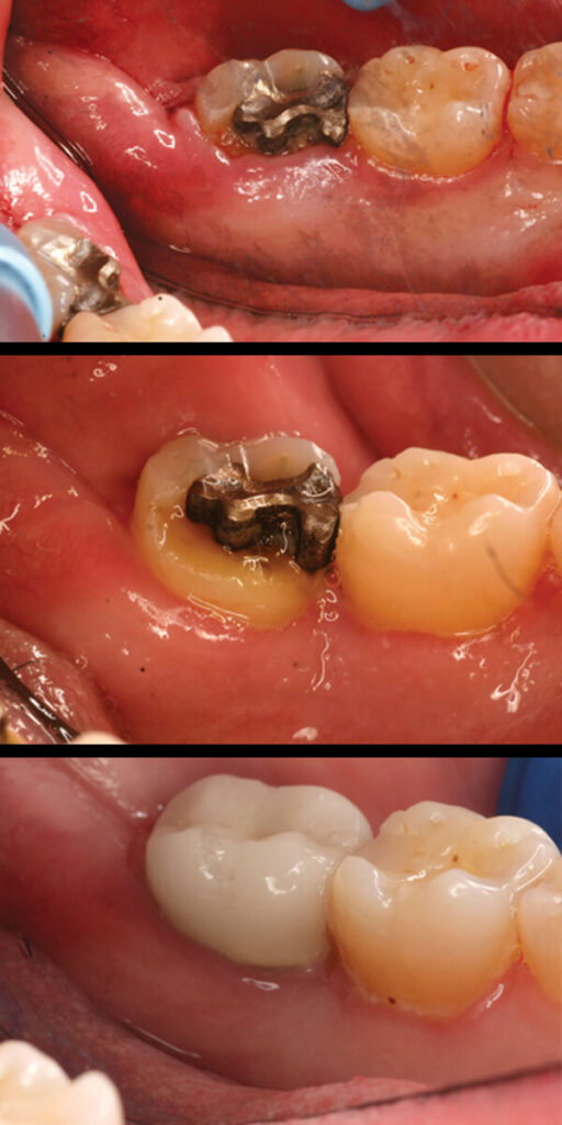 Picture of before and after crown lengthening in 3 stages.